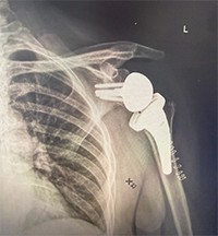 Ms. Monica Christie : Left Reverse Total Shoulder Replacement Success Story